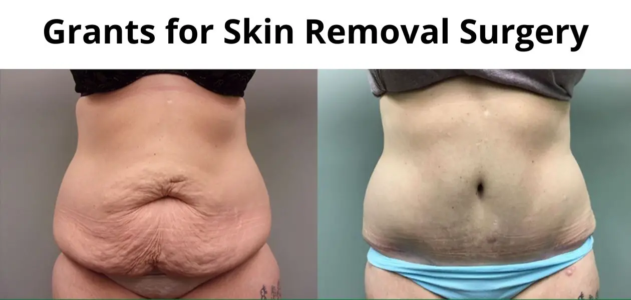 Skin Removal Surgery Grants in 2022